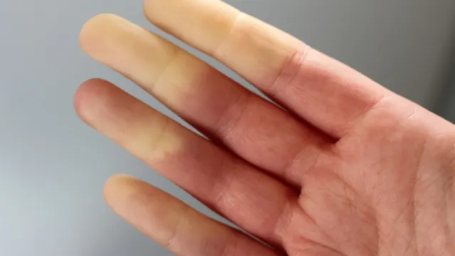 Raynaud's syndrome